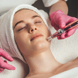 microneedling treatments